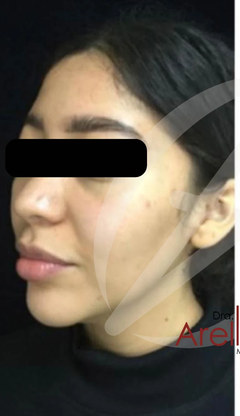 Armonización facial antes — paciente 2 de Dra. Dafne Arellano, Puebla