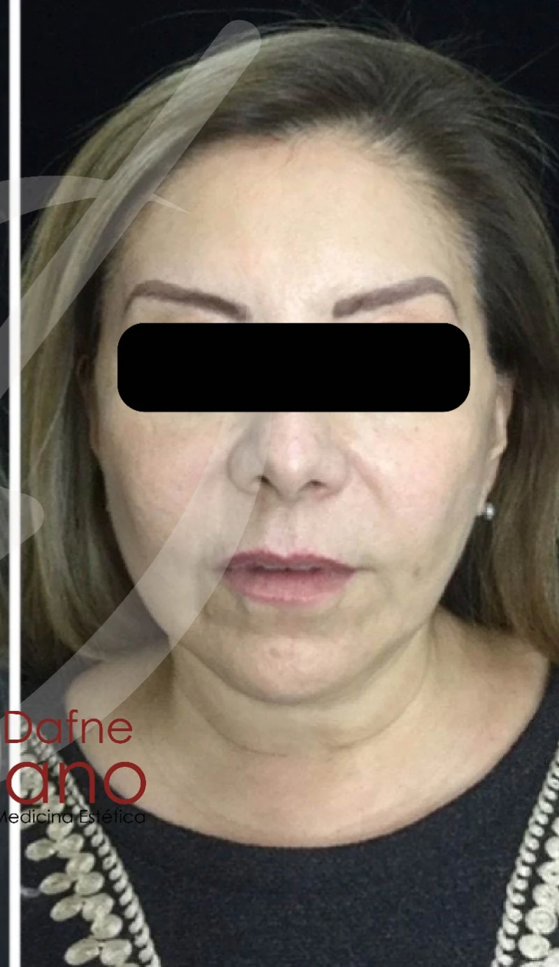 Armonización facial después — paciente 3 de Dra. Dafne Arellano, Puebla