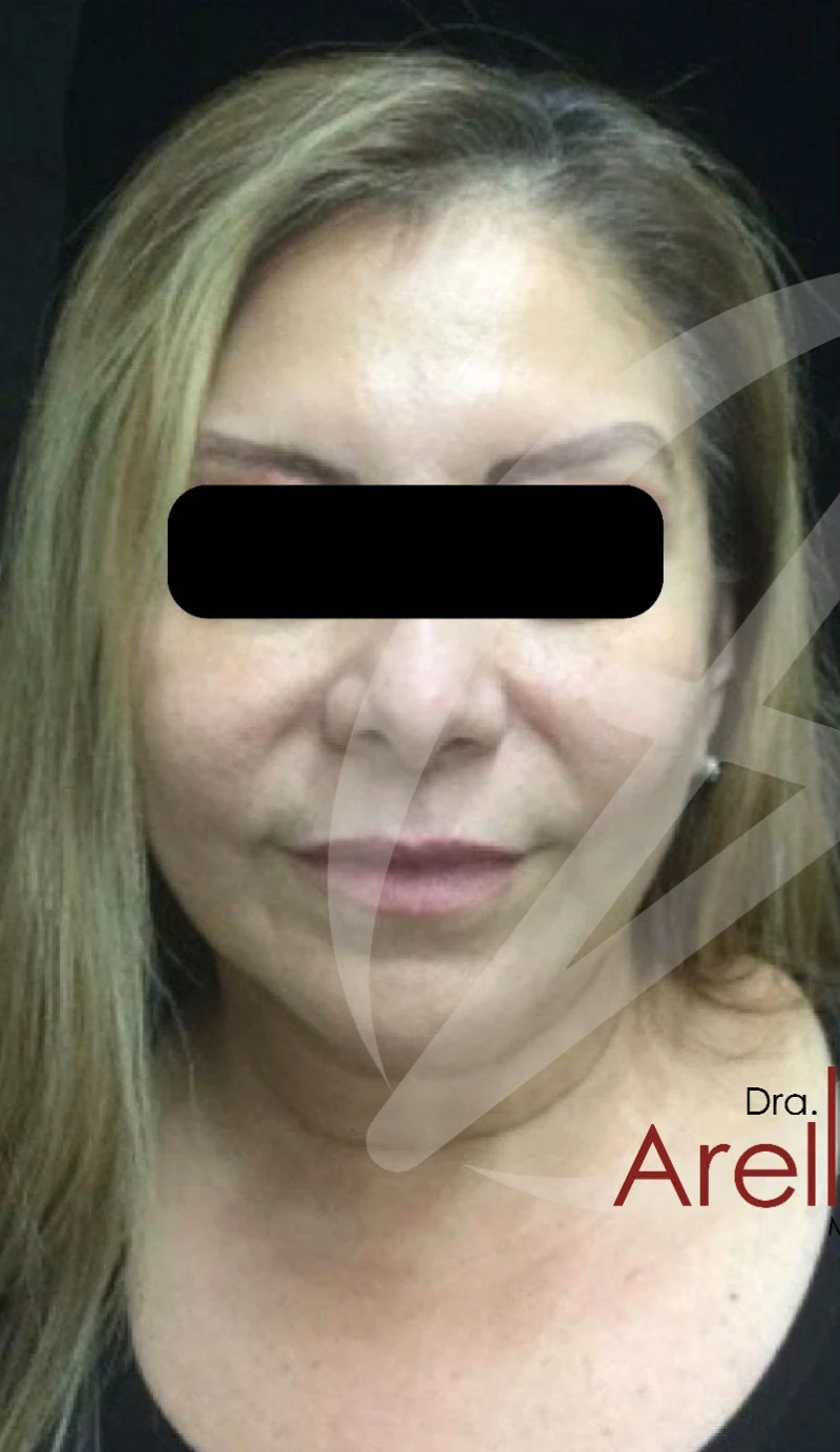 Armonización facial antes — paciente 3 de Dra. Dafne Arellano, Puebla