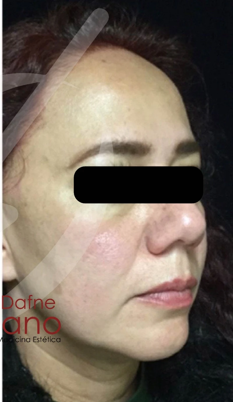 Armonización facial después — paciente 5 de Dra. Dafne Arellano, Puebla