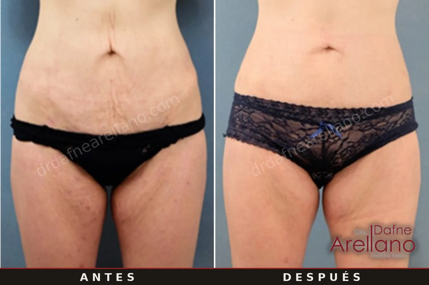 Evidencia clínica EndyMed — tensado de abdomen antes y después, resultados del fabricante