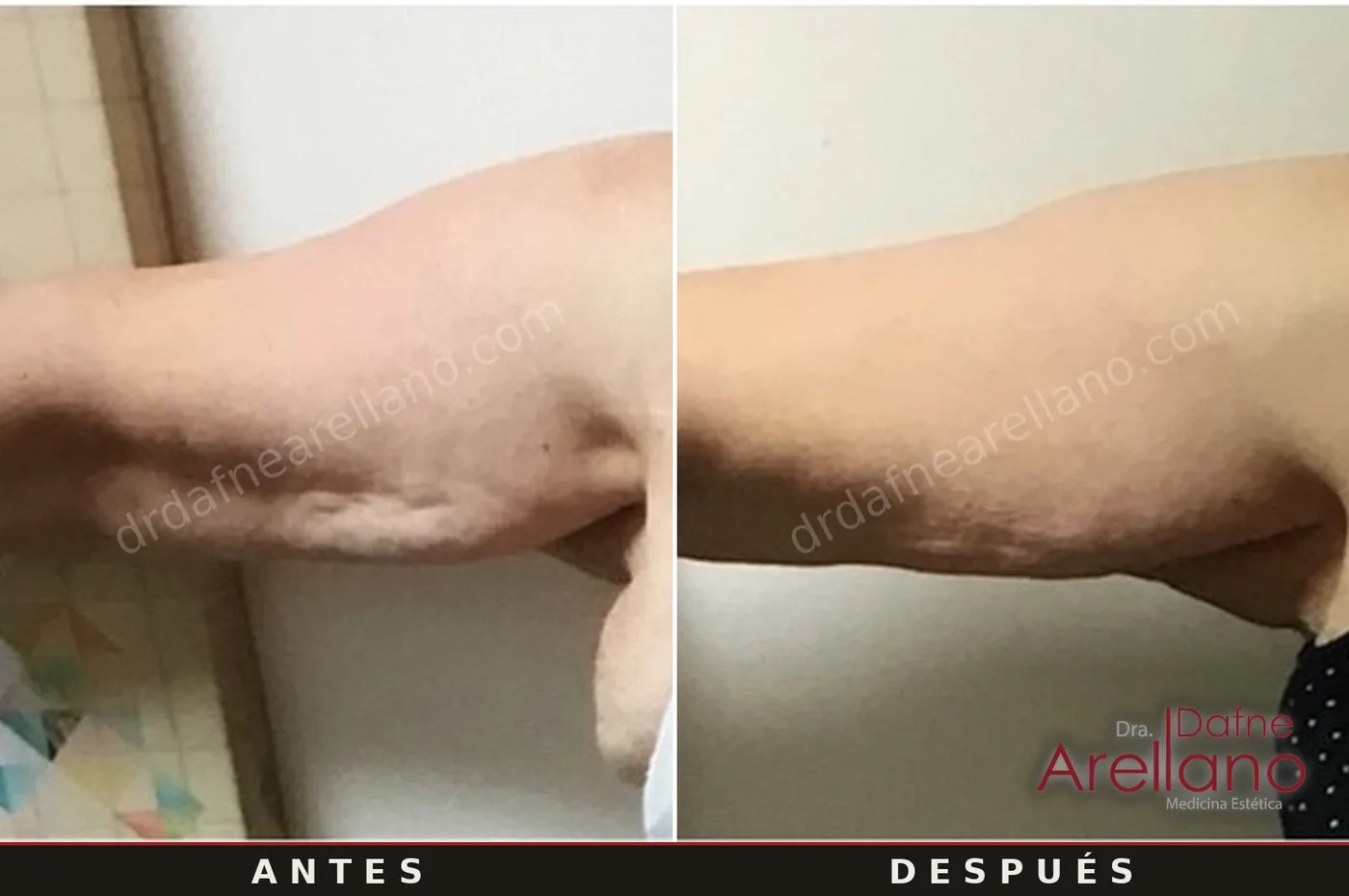 Evidencia clínica EndyMed — flacidez de brazos antes y después, 7 sesiones