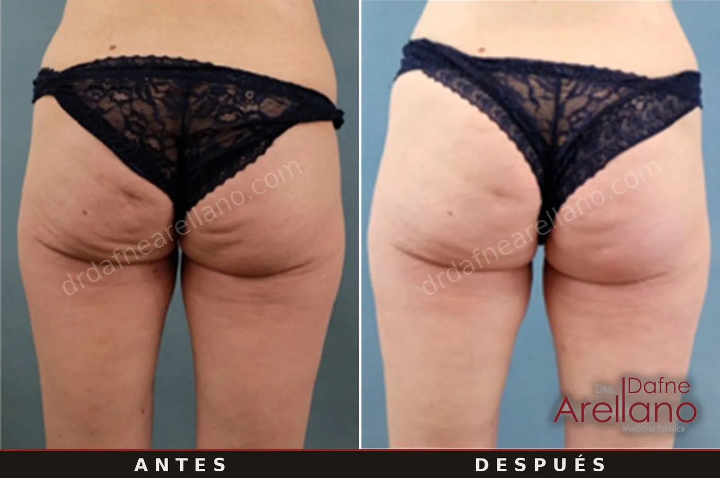 Evidencia clínica EndyMed — tensado de glúteos y celulitis antes y después