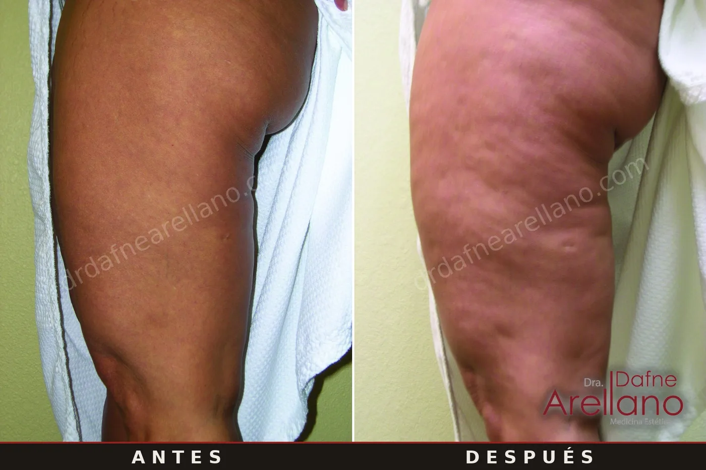 Evidencia clínica EndyMed — flacidez y celulitis de muslos antes y después