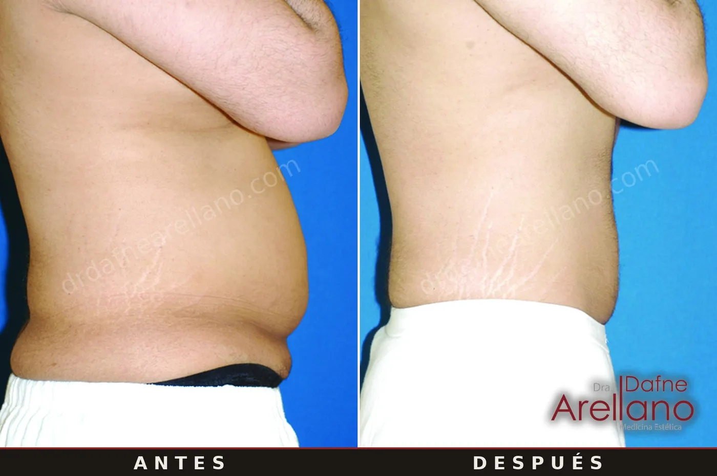 Evidencia clínica EndyMed — contorno corporal lateral antes y después, 21 sesiones