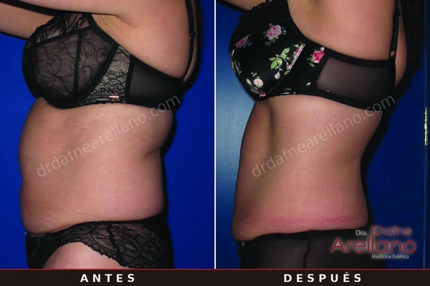 Evidencia clínica EndyMed — tensado de torso antes y después, resultados del fabricante