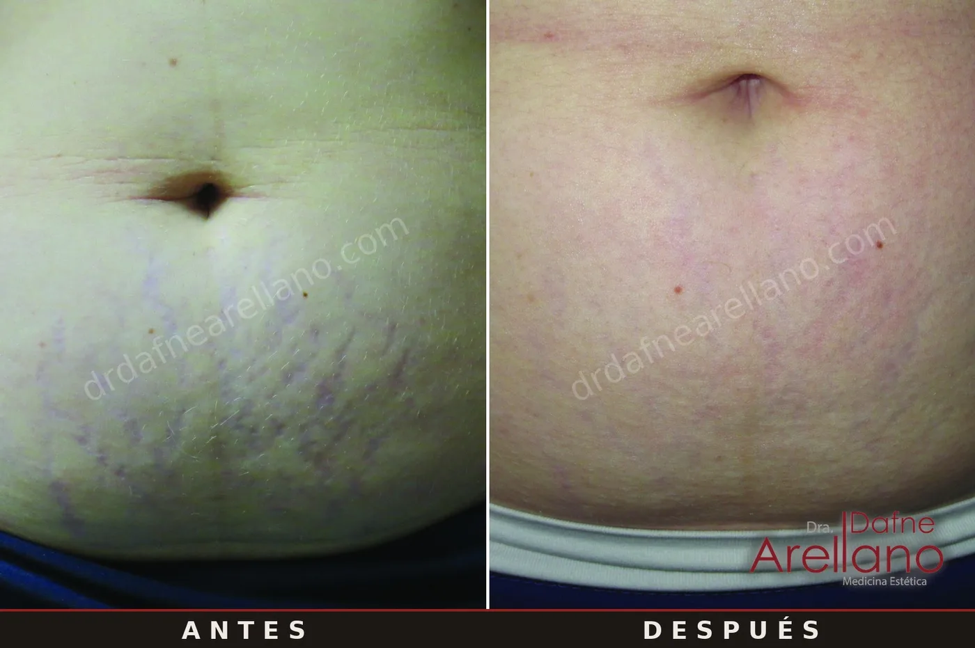 Evidencia clínica EndyMed Intensif — estrías abdominales antes y después, resultados del fabricante (Canadá)