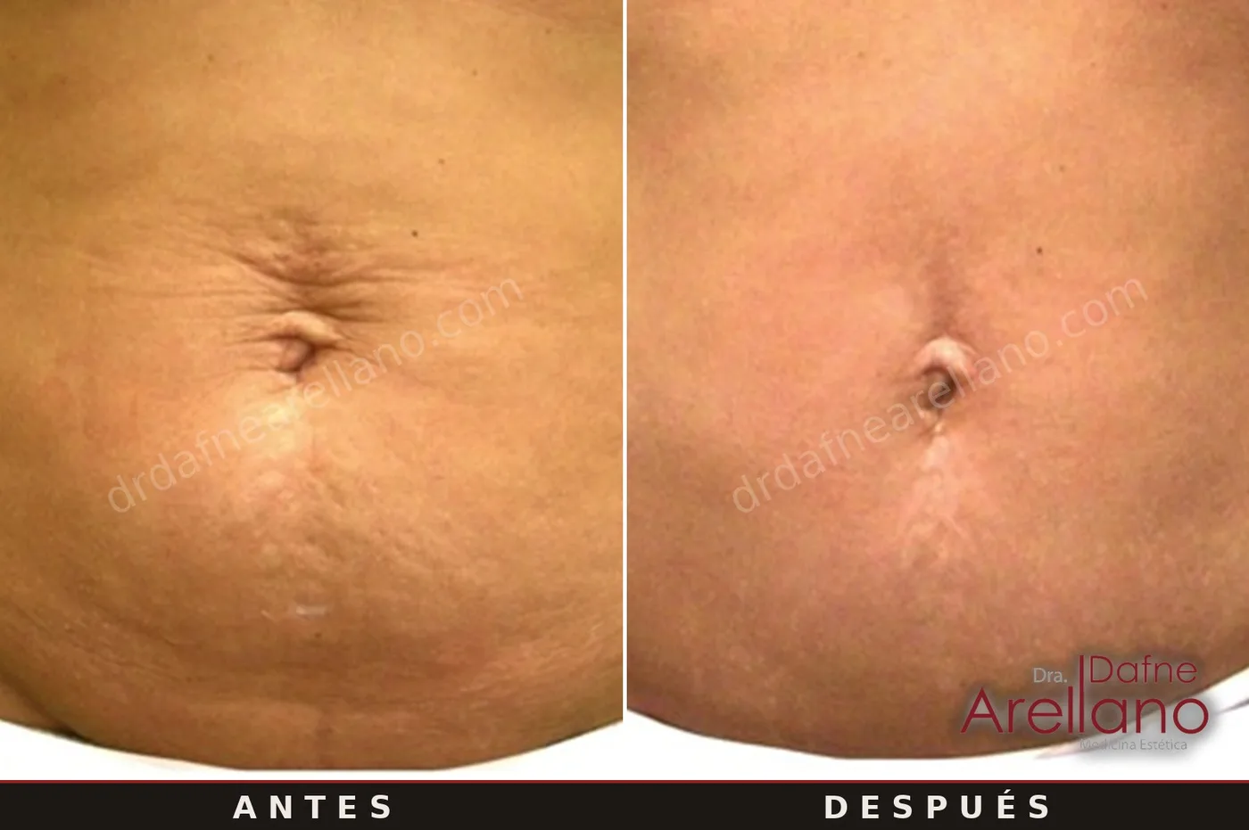 Evidencia clínica EndyMed Intensif — abdomen con estrías, 6 sesiones, resultados del fabricante (EUA)