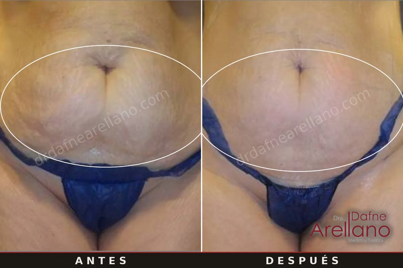 Evidencia clínica EndyMed Intensif — abdomen postparto con estrías, 6 sesiones, resultados del fabricante (España)