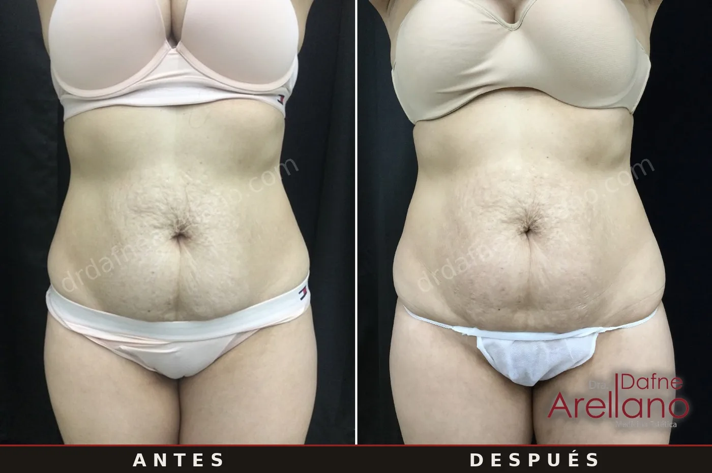 Caso clínico 1 — estrías en abdomen tratadas con radiofrecuencia con microagujas EndyMed Intensif, antes y después, Dra. Dafne Arellano, Puebla
