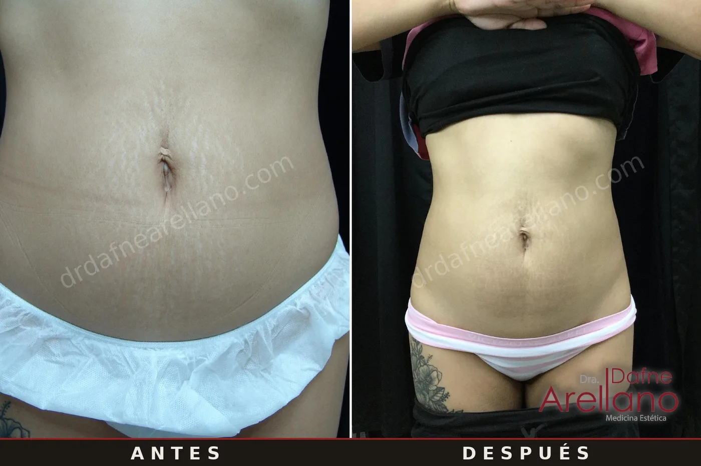 Caso clínico 2 — estrías blancas en abdomen, antes y después del tratamiento con EndyMed Intensif, Puebla