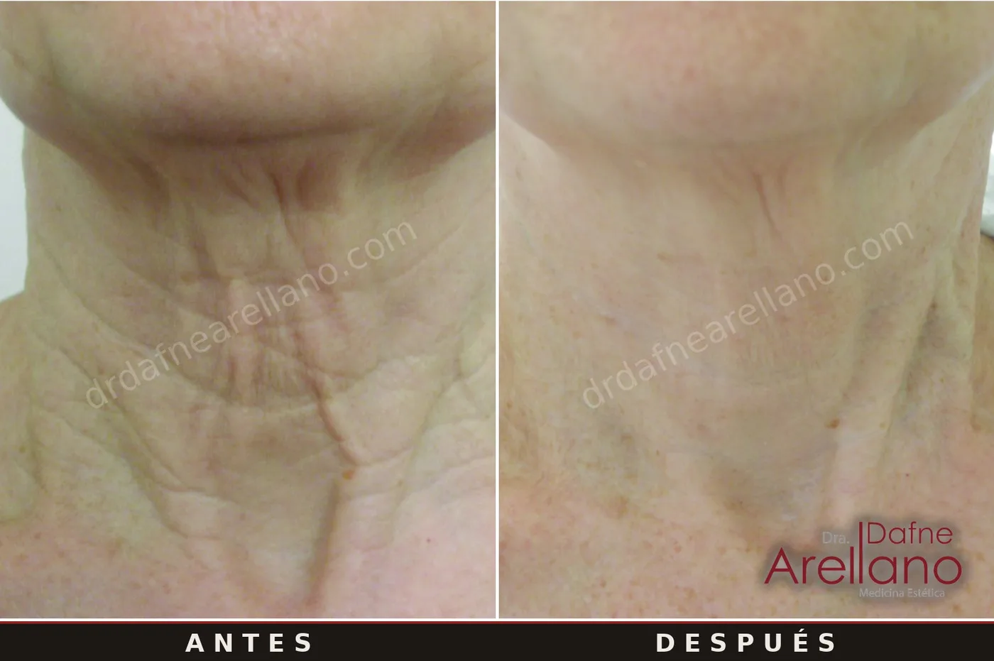 Evidencia clínica EndyMed — tensado de cuello antes y después, resultados del fabricante