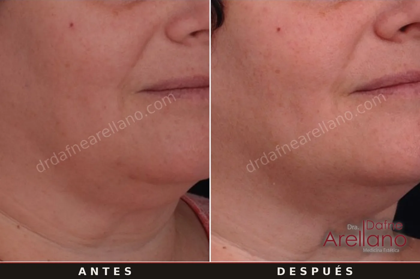 Evidencia clínica EndyMed — jawline y óvalo facial antes y después, 4 sesiones