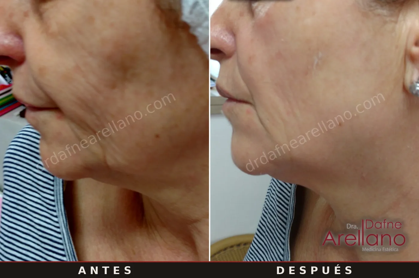 Evidencia clínica EndyMed — tensado del óvalo facial antes y después, 4 sesiones