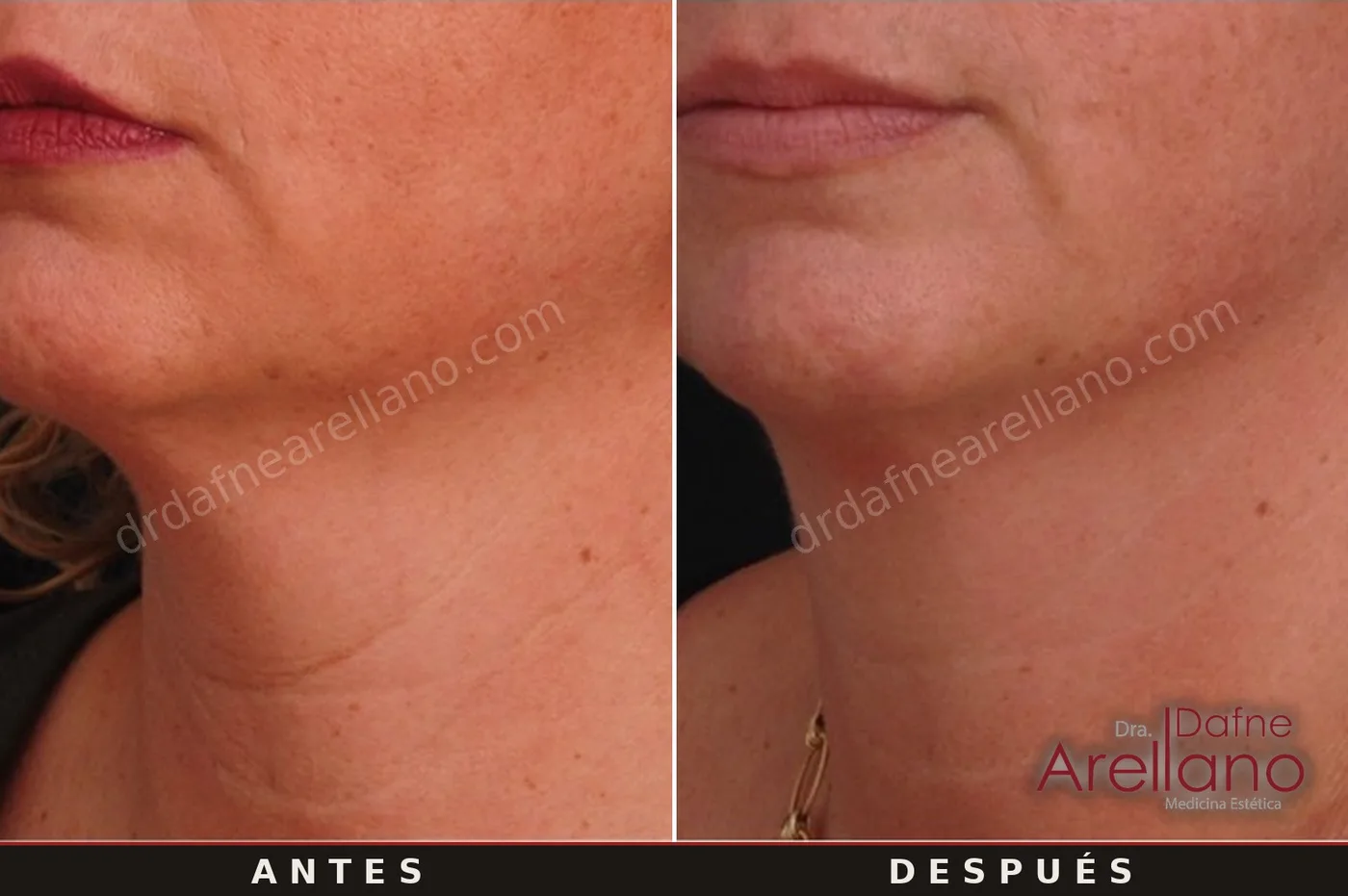 Evidencia clínica EndyMed — papada y definición mandibular sin cirugía antes y después