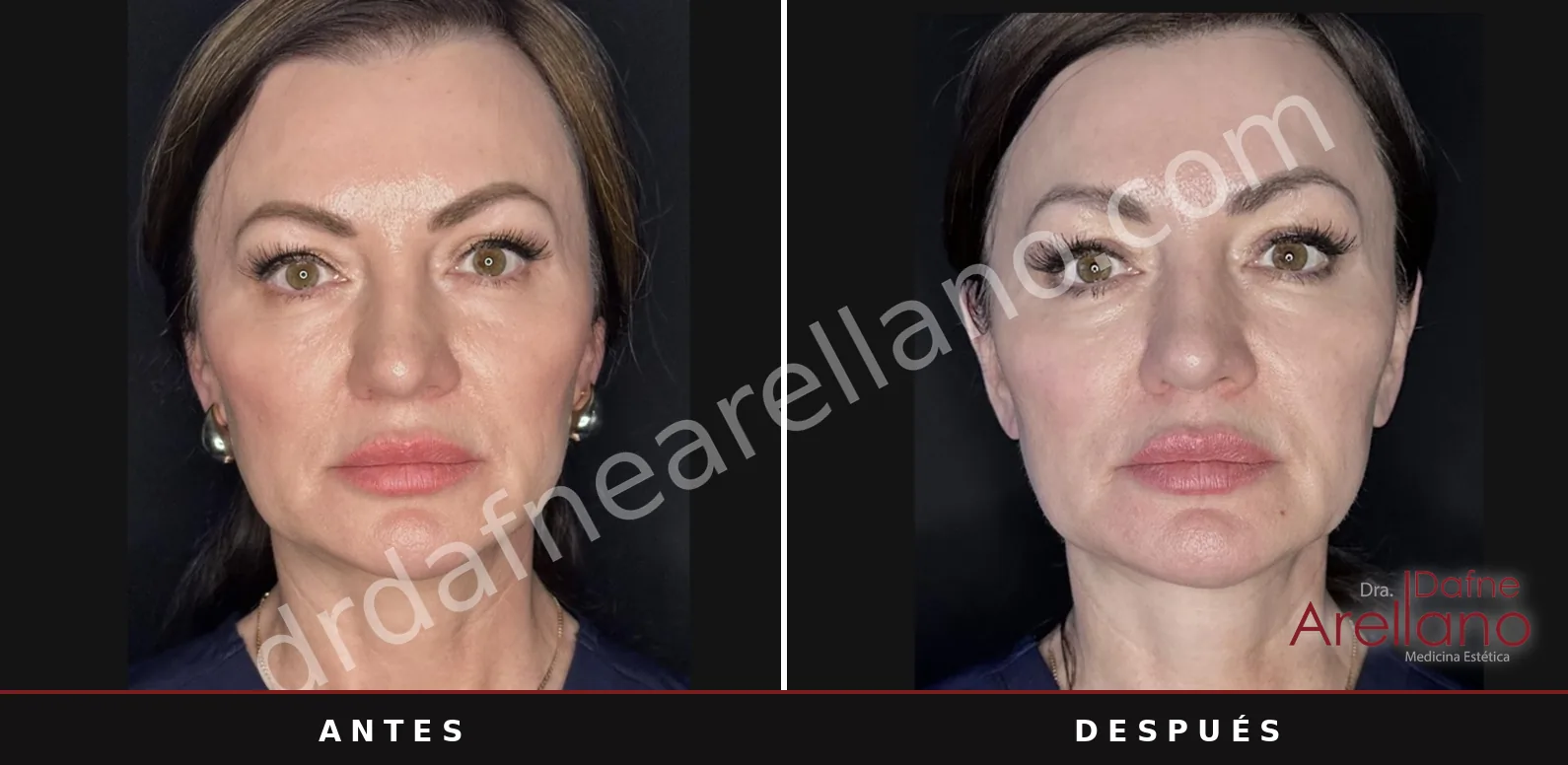 Sofwave antes y después, líneas y arrugas del rostro: 3 meses después de una sesión
