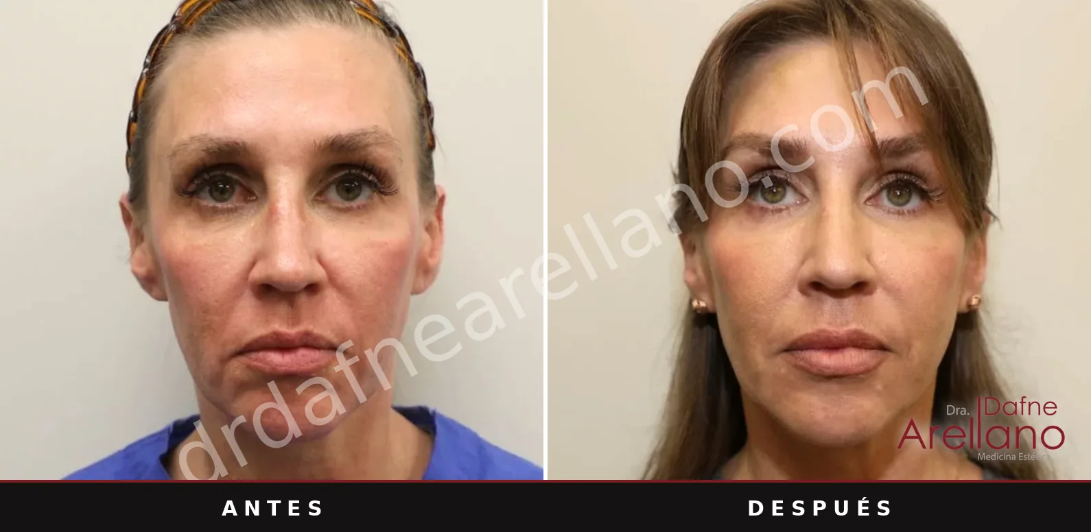 Sofwave antes y después, rostro: 2 meses después de una sesión