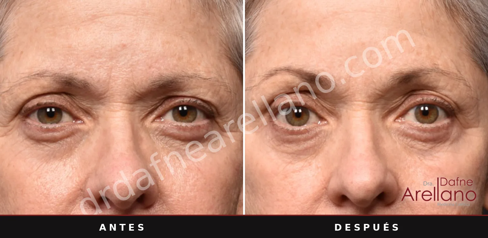 Sofwave antes y después, cejas y mirada: 12 semanas después de una sesión
