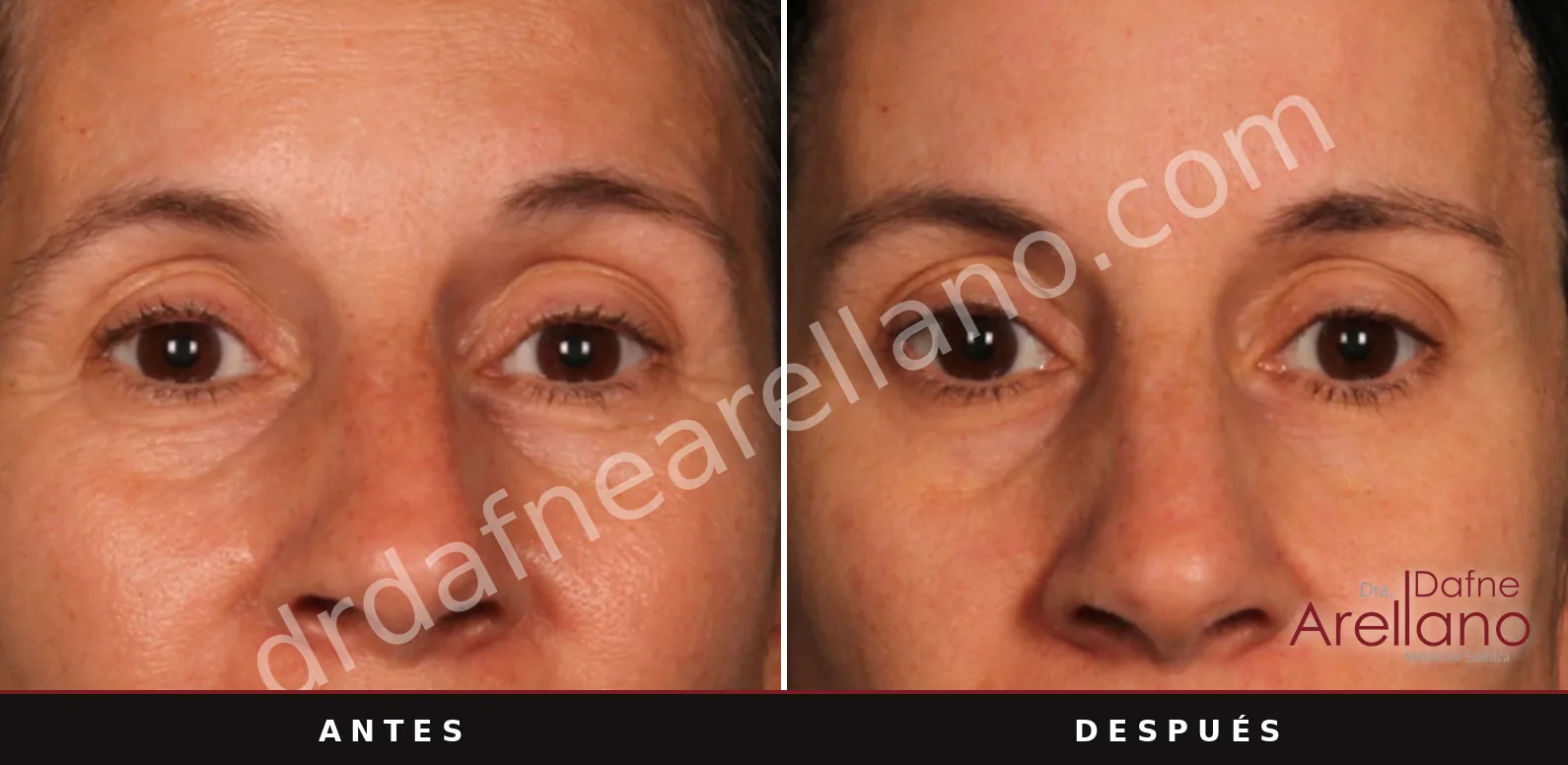 Sofwave antes y después, cejas: 12 semanas después de una sesión