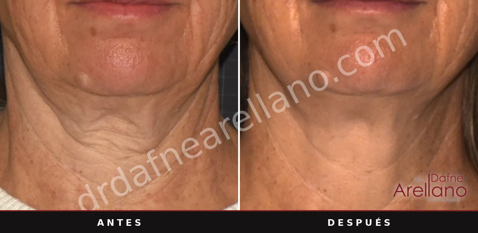 Sofwave antes y después, cuello: 12 semanas después de una sesión