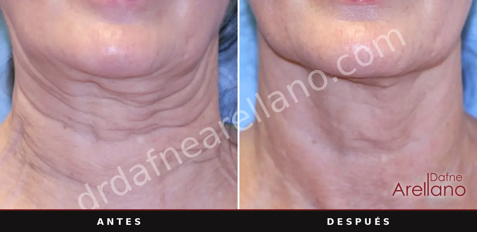 Sofwave antes y después, cuello: 10 meses después de una sesión