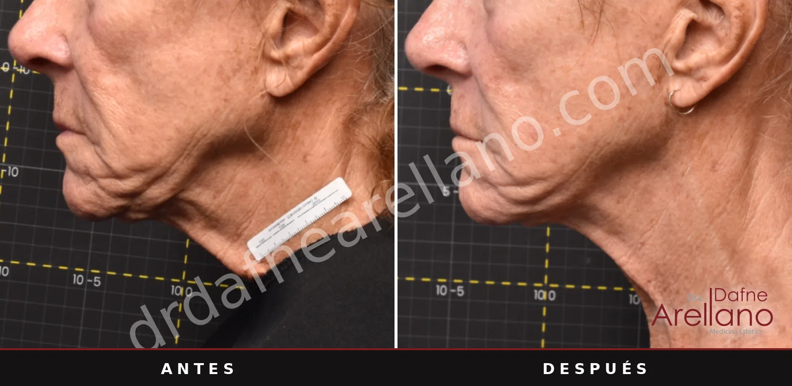 Sofwave antes y después, papada y cuello: 9 semanas después de una sesión