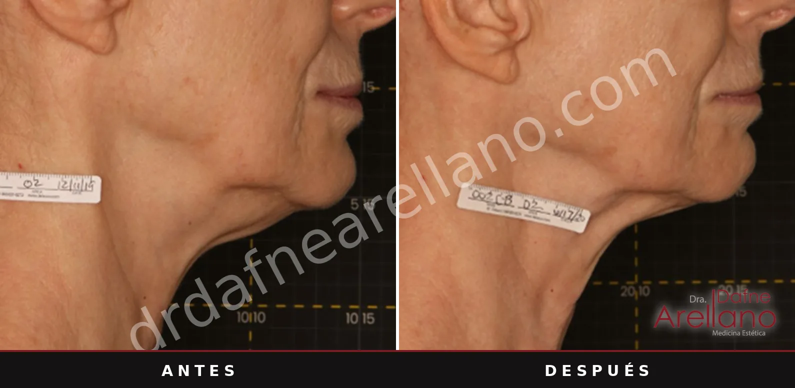 Sofwave antes y después, papada: 6 meses después de una sesión