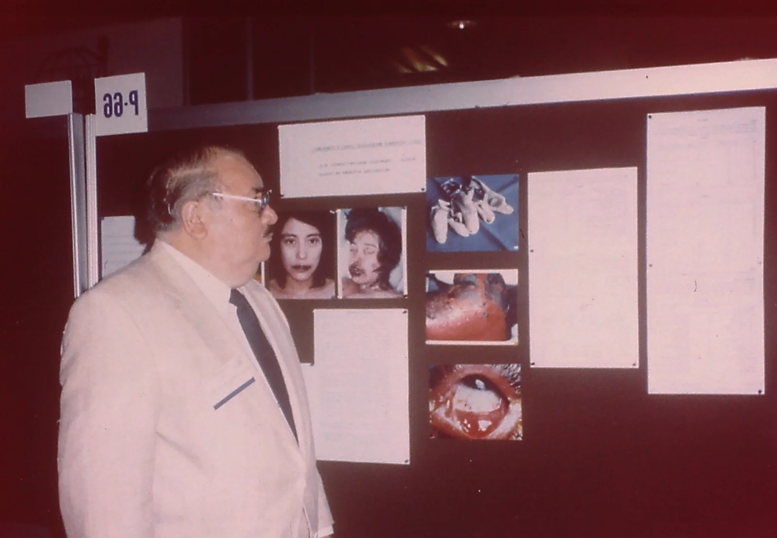 Profesor Dr. Francisco Arellano Ocampo en sesión de pósters de congreso internacional de dermatología, evaluando trabajo científico marcado P-66 — fotografía de archivo familiar