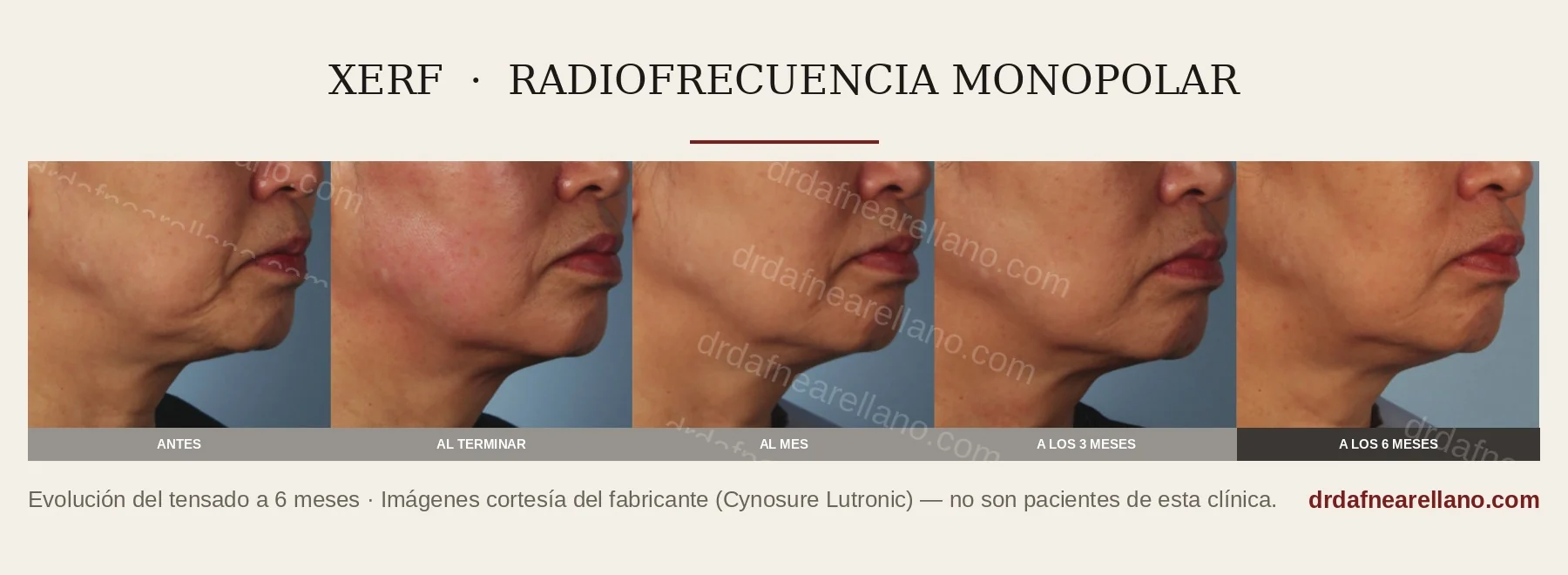 Evolución del tensado con radiofrecuencia XERF: antes, al terminar, al mes, a los 3 meses y a los 6 meses